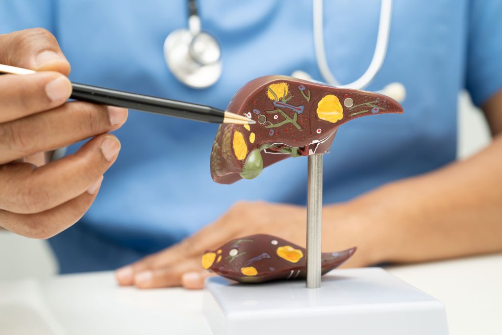 Fatty liver model.