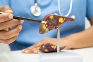 Fatty liver model.